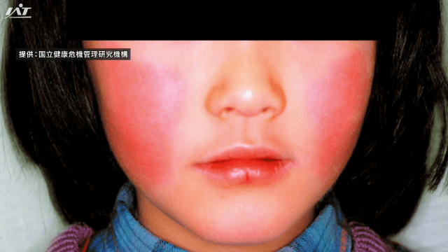 リンゴ病　過去最多に　百日せき　以前高止まり【岩手】